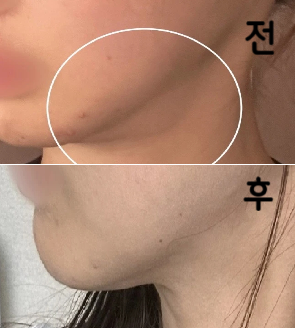 침샘이 늘 고민이었는데 오랜만에 맞아봤어요. 디자인 꼼꼼히 바로바로 해주셨어요!
