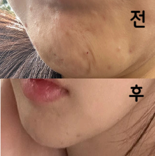 자갈턱 보톡스는 처음이에요 대기 길지 않았고 실장님도 친절하세여. 주사 무서워하는 저도 잘 맞고 왔구 개인적으로 만족스럽습니다!