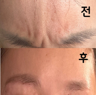 미간보톡스 맞았어요 빠르게 끝났고 설명을 친절히 해주셔서 마음 편하게 받았어요~
