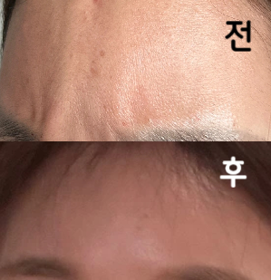 눈썹말고 이마하길 잘 한거 같아요 근본적인 원인을 찝어주시네요! 원장님도 포인트만 콕콕 해주시는 거 넘 좋네요 굿~