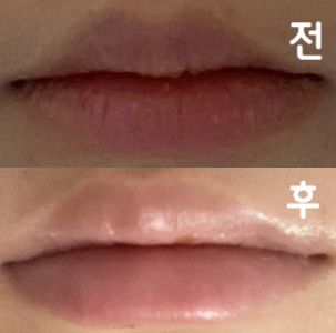 필러 후 부작용 등을 정말 구체적으로 말씀해주셔서 지인들에게도 충분히 추천 할 만한 병원 같아요!