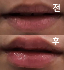 긴장해서 눈물이 나왔는데 상냥하게 말 걸어주시고 눈물 닦아 주셔서 정말 안심하고 시술 받을 수 있었습니다! 무조건 다시 갈게요! 고마웠습니다!