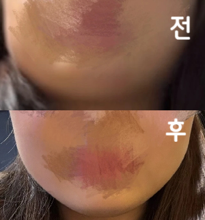 경과 지나봐야 알겠지만 얼굴 지방 많은 부분에 집중적으로 더 많이 넣어주셔서 더 기다리면 효과가 있을 것 같아요~