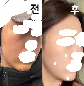 지금 일주일 다 되어가는데 얼굴 선이 정리되는 것 같아서 만족하는데 이중턱은 안 사라져서 또 맞긴 해야겠어염