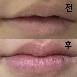 원래 밑에 있던 입꼬리가 이쁘게 올라가서 완전 만족!!