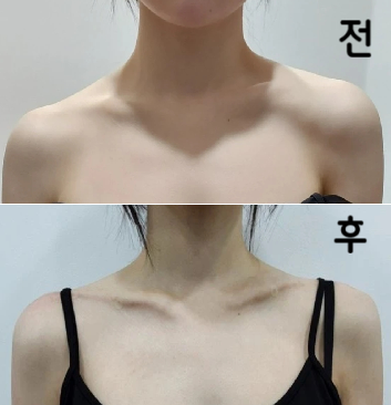 빼빼로주사 지난 번에도 효과 있었고, 이번이 세 번째였기 때문에 효과가 뛰어났다고 생각합니다!