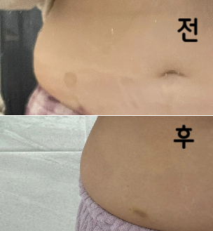 살이 많아서 드라마틱하진 않지만 라인 정리되고 더 하면 효과 볼 거 같아요..!