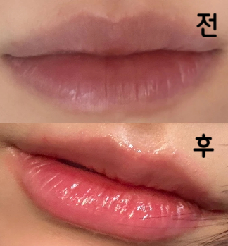 입술필러가 처음이어서 걱정을 많이 하고 갔는데 상담도 너무 친절하게 해주시고 권유도 하나두 없으셨습니다!!