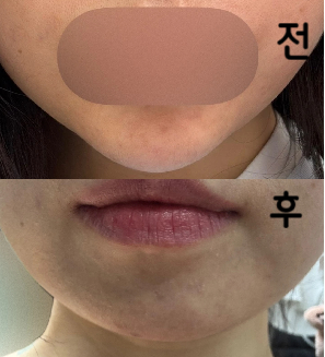 다른 병원에서 못 녹인 거 여기서 다 녹여줍니다 ㅜㅜ 강추예욤!