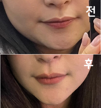 턱라인이 확실히 정리된게 눈에 보여요~ 이중턱이 잘 빠진 것 같아요~