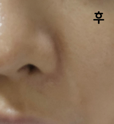 팔자주름 이물감 심했는데 녹이고 훨씬 나요 ㅠㅠ 감사합니다!