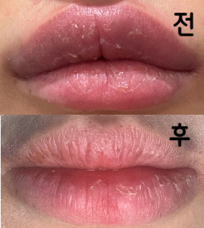 잘 녹여주셔서 원상복구 됨! 생각보다 안 아프고 선생님 섬세함~