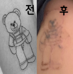 아주 미세하게 옅어지는 중, 눈 코 입 부위는 타투 시술 시 깊이 들어가서 제거하는데 시간이 오래 걸린다고 하심~
