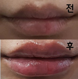 거울로 확인하면서 만족할 때까지 주입 해 주셨어요! 너무 만족스러워요!