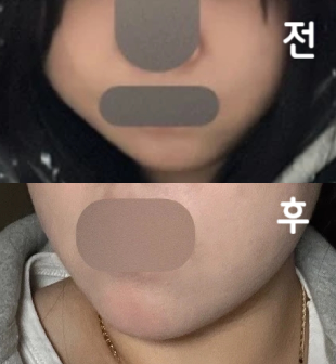 다른 곳보다 저렴한 비용으로 더 많은 양을 맞을 수 있어서 좋았어요!!