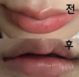 전에 입술필러 맞은 곳에서 만족을 못해서 찾아왔는데 너무 친절하셨고 원하는 디자인도 꼼꼼하게 체크해주셨어요~