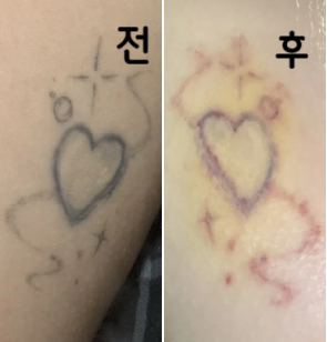 다들 아프다고 해서 걱정 많이 하고 시술 들어갔는데 하나도 안 아팠습니당.. 경과 보고 더 다니려구요~