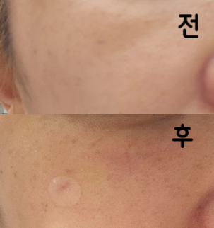 저번에 풀필러 맞다시피 했는데 조금 꺼진 부분이 있어서 1cc 더 보충하고 왔습니다!!