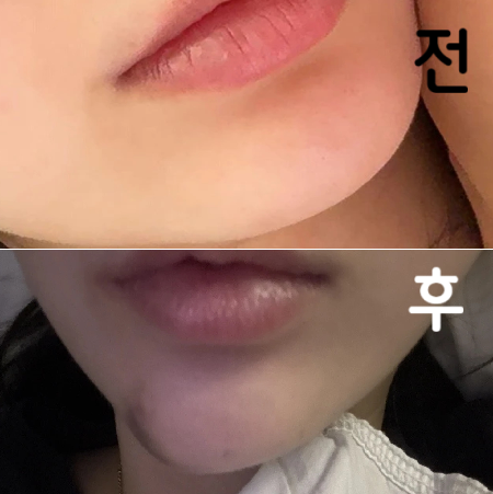 필러 넣어주신 의사님이 엄청 친절하게 설명도 잘 해주시고 모양도 엄청 이쁘게 놔주셨어용~