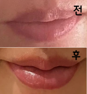 입술모양에 볼륨을 원해서 수술로 필러를 추가했어요. 예쁜 모양으로 완성되었습니다~