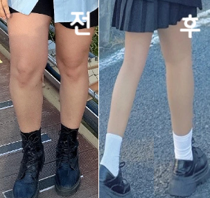 복부 얼굴 같이 진행했는데 확실히 시술 효과랑 동기부여도 같이 받아 시술하는동안 꾸준하게 운동이랑 식단도 놓지 않을 수 있었어요!
