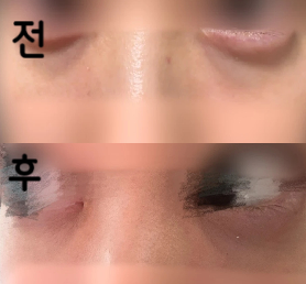눈 밑 다크써클에 울트라콜을 1cc씩 넣었습니다~