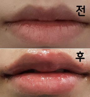 전보다 더 많이 넣어 이상적인 입술을 만들 수 있어서 대만족이었습니다!