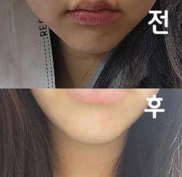 요구사항 잘 들어주시고 2회차인데 효과가 너무 좋아서 한 번 더 맞으려구요~