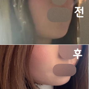 진짜 작아졌고 이중턱도 많이 좋아졌어요!