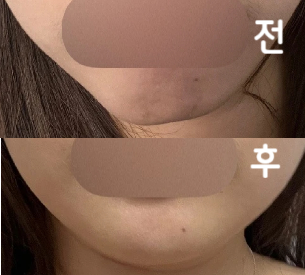 지인이 평소 방문하던 병원이여서 추천 받고 갔는데 너무 친절하셨고 관리법에 대해서도 자세히 알려주셔서 좋았습니다!