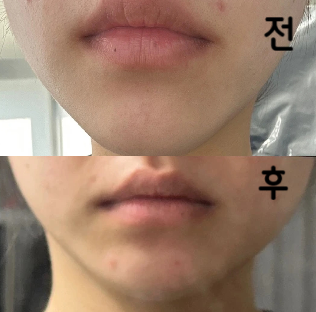 붓기 빠지고 고민이었던 턱라인이 보이기 시작했어요~ 두 번 이상 맞으시는 거 추천드립니당~