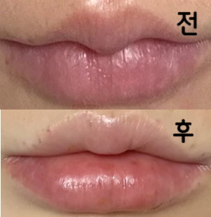 시술해주신 원장님 엄청 자상하셨고 시술도 만족스러워요~
