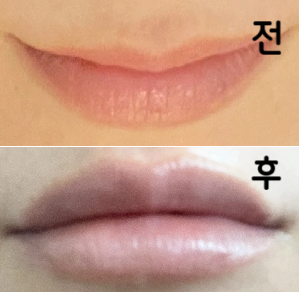 입술이 얇은 편이라 2cc 무제한 추천 받아 맡겼습니다! 조금 부었지만 매우 만족합니다~