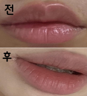 병원 분위기, 직원분들 너무 친절하셨고 상담 해주신 실장님도 너무 친절하게 상담 잘 해주셨음!