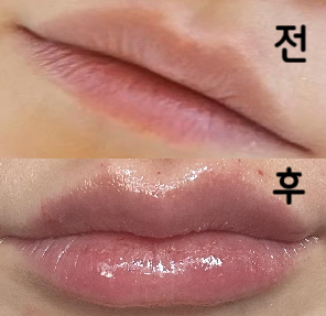 항상 예쁘게 모양 나오고 가격도 부담 없어서 입술 필러는 항상 롤리팝에서만 받아요!