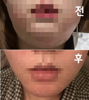 효과 좋아서 주기적으로 맞고 있어요! 2주차 될 때 제일 효과 잘 보이는 것 같아요!