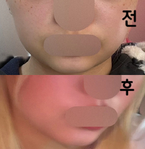 저는 심부볼/ 브이라인 여기가 제일 큰 고민이었는데 붓기 빠지자마자 확연하게 브이라인이 둔턱 -> 평평으로 바뀌었어요!