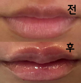 생각보다 통증도 없었고 일본에서 하는 것보다 훨씬 할 수 있어서 좋았습니다!!