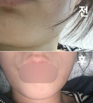 얼굴이 작아지는 거 같아서 한 번 더 받으러 가려구요~