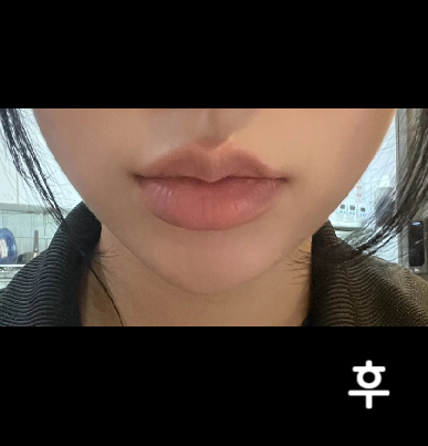 롤리팝에서 갸름주사 총 3회 맞았어요! 저렴한 가격대에 꽤 효과 조아여~ 주기적으로 맞으려구요~