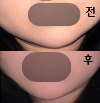 두 번째 맞았는데 효과도 좋고 확실히 얼굴이 작아진 게 느껴지고 갸름해졌어요!