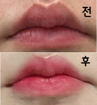 리터치 가능한 점이 가장 맘에 들었고 니즈에 맞게 시술 잘 해주셔서 감사합니당~