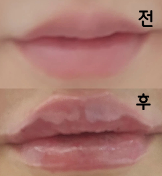 시술 시 필러제 직접 보여주시고 개봉 해 주셨구요! 여의사 선생님께서 친절하게 입술 디자인 해주시고 꼼꼼하게 시술 해 주셨습니다!