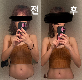 인생 두 번째 지방용해주사였어요~ 정중하고 신속한 대응과 시술, 접객 모두 최고였습니다!