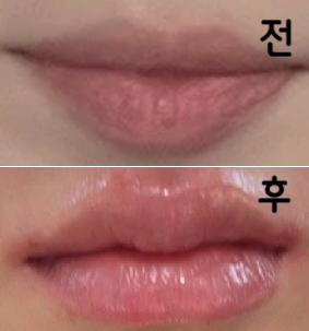 친구가 여기 병원에서 입술필러 맞았는데 너무 예뻐서 바로 예약 잡음! 가격이 너무 착해서 좀 불안했는데 맞고 나서 너무 맘에 듬 ㅜㅠㅜ