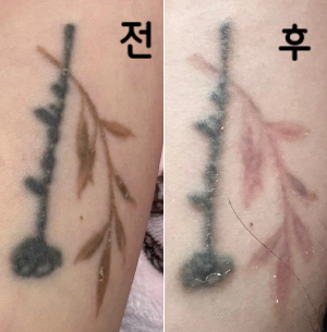 물집 있던 곳 딱지 떨어지니 많이 옅어진게 보임!