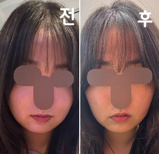 얼굴 ㄹㅇㄹㅇㄹㅇ 갸름해짐! 진짜 감사합니다 2주 뒤에 또 갈거에요 진짜!!