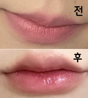 입꼬리 처짐, 웃을 때 한 쪽만 올라감, 입술 주름, 얇음이 고민이었는데 비대칭 생각해서 양쪽 필러 양 다르게 해주셔서 대칭이 어느정도 맞춰졌어요~