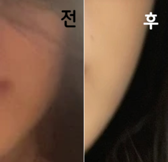 친구들이 보고 엄청 갸름해졌다고 진짜 효과 좋은 것 같다고 함! 그래서 2회차 맞으러 갈거임!
