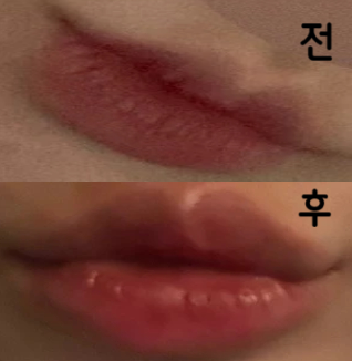 다들 엄청 친절하셨고 입술필러랑 입꼬리보톡스 같이 맞았는데 만족합니다!!